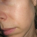 This is my face about 10 months after the last IPL. This was taken July of 2011. I have only had 2 IPLs but they really changed the texture of my skin quite a bit. This texture is very ugly and "aged". I am 37.