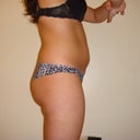 One day prior surgery