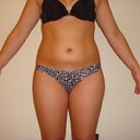 One day prior surgery