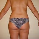 prior surgery