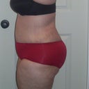 post op day 20
