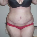 Ugh i really hope most of that is swelling not fat!