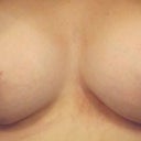 one month postop