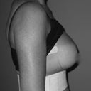 4 days post op