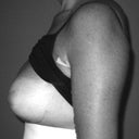 4 days post op