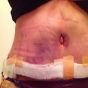 Is this bruising normal?  This the 4th day post op.