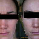 These are the images of before and after the second peel ( spaced three weeks apart at 15%).  This was about 3 weeks after the peel to show the 'finished' results.  I see no difference! BOO!!