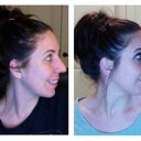 Before and 3.5 weeks post-op.