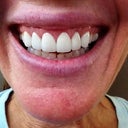 First veneers. Too big, too white, too opaque. Placed too close to the bone causing redness, swelling and bleeding