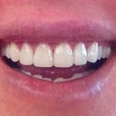 Second final veneers. Pretty happy except for the large  black triangle gaps between both lateral incisors.