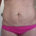 This was before surgery, after weight loss, at 136 pounds while "sucking in"