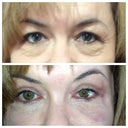 Upper picture 1 day prior to surgery and lower picture Day 12 with full war paint for the first time.