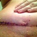 Incision scanning over and healing well