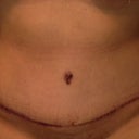 Incision beginning to heal although I'm SUPER swollen