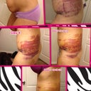 Progression of side view, look how fast my bruising is disappearing.