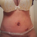 2wks PO Steri-Strips changed, bruising fading and drain holes healing well. So glad my tummy is FLAT!! :D