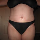 6 weeks Post-Op