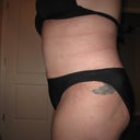6 weeks Post-Op