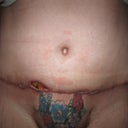 6 weeks Post-Op
