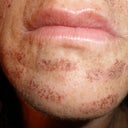 burnt chin