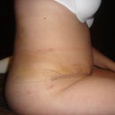 After Tummy Tuck