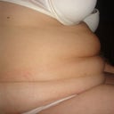 Before Tummy Tuck