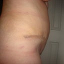 2 weeks after Tummy Tuck