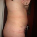 5 weeks after Tummy Tuck