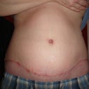 6 weeks/ 2 areas with infection but healing good
