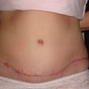 scar at 9 weeks