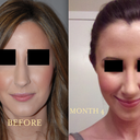 BEFORE VS. MONTH 4