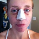 Day 2, turning into a yellow chipmunk. Can't move my upper lip much.