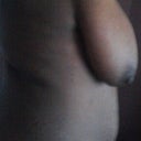 Before surgery (side)