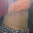One week and one day from endo ab muscle repair.  You see the upper bulge just above my BB still.