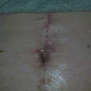 BB at 5 wks PO
