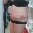 Left side with bruising at the flanks