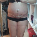 Close up of incision area and new bbutton!