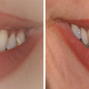 Crown Lengthening 