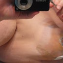 6 days post op righty