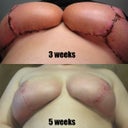 Looking at this picture, I can see just how swollen my breasts really were, only a few weeks ago. Wow.