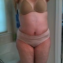 3 weeks out still some swelling. Bruising has disappeared.