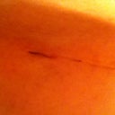 9 days post op, scar under my left breast