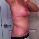 100 days post op - side view