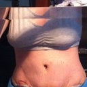 3 days post op.