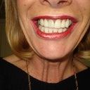 After picture, I never opened my mouth before!!