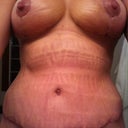 PO day 24. Still have swelling in abs. All scabs are off incision and bb and I can finally start scar maintenance.