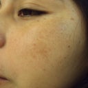 Chemical Peels
