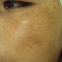Chemical Peels