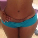 Scar easily hidden but I pulled down so you can see