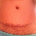 Scar and belly button
